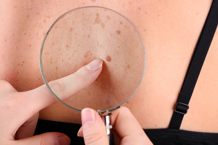 Dermatologist examines birthmark of patient, close up